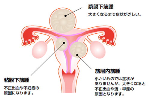 子宮筋腫